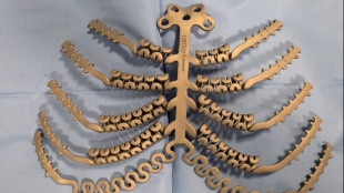 A Modena sterno in titanio su paziente affetta da carcinoma